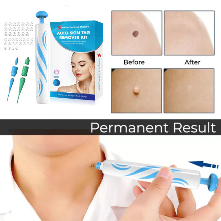 Skin Tag Removal Kit