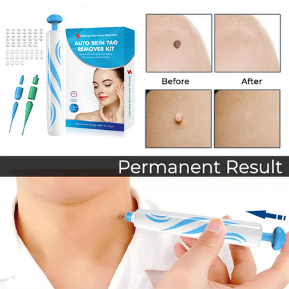 Skin Tag Removal Kit