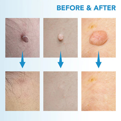Skin Tag Removal Kit