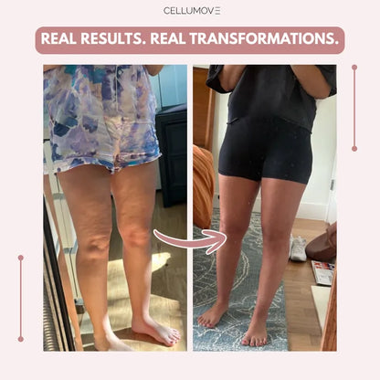 Stycove 3D Legging – Say goodbye to lipoedema pain and swelling naturally