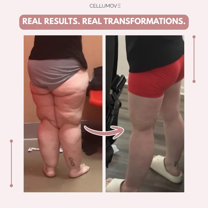 Stycove 3D Legging – Say goodbye to lipoedema pain and swelling naturally