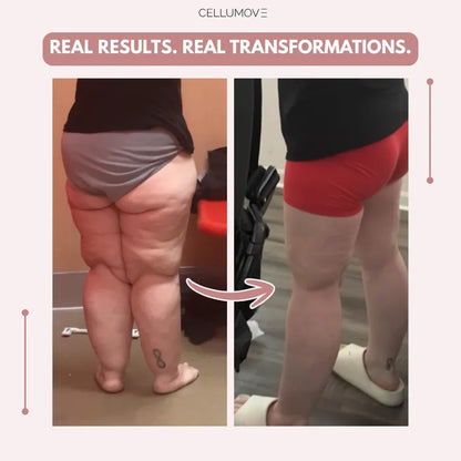 Stycove 3D Legging – Say goodbye to lipoedema pain and swelling naturally
