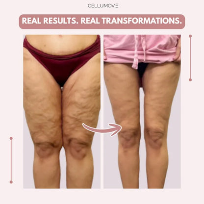 Stycove 3D Legging – Say goodbye to lipoedema pain and swelling naturally