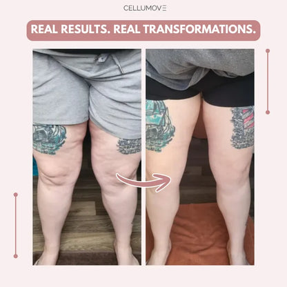 Stycove 3D Legging – Say goodbye to lipoedema pain and swelling naturally