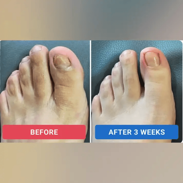 Nail Repair Patches