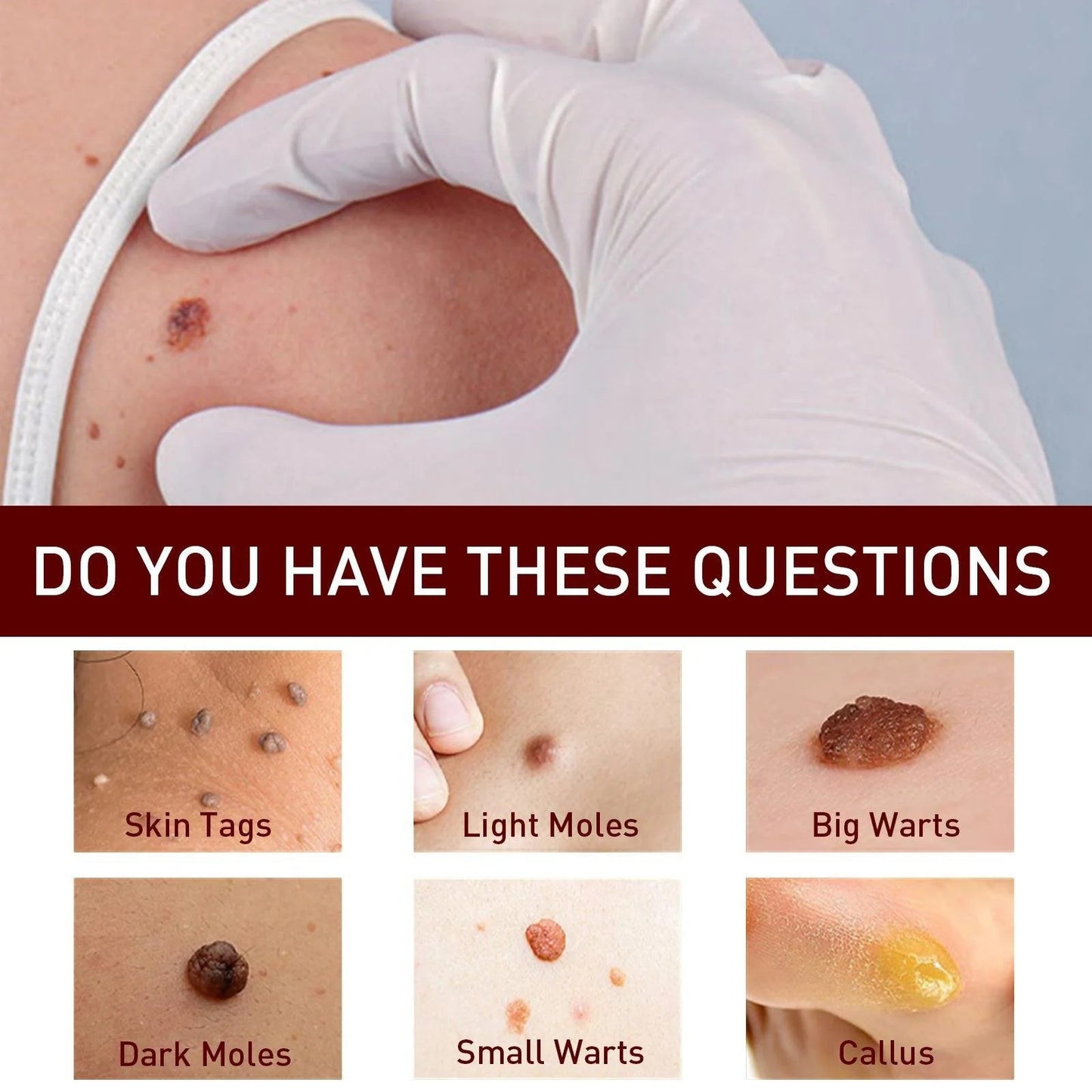 Best Sellers - Tags & Moles Remover——10 pcs