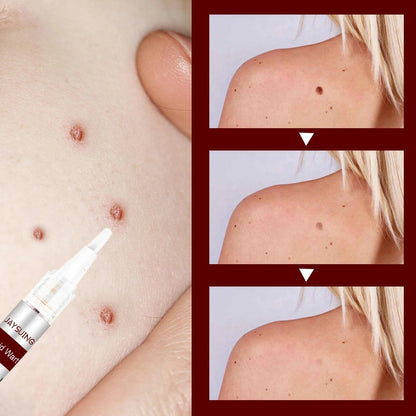 Best Sellers - Tags & Moles Remover——10 pcs
