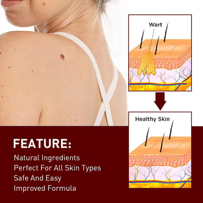 Best Sellers - Tags & Moles Remover——10 pcs