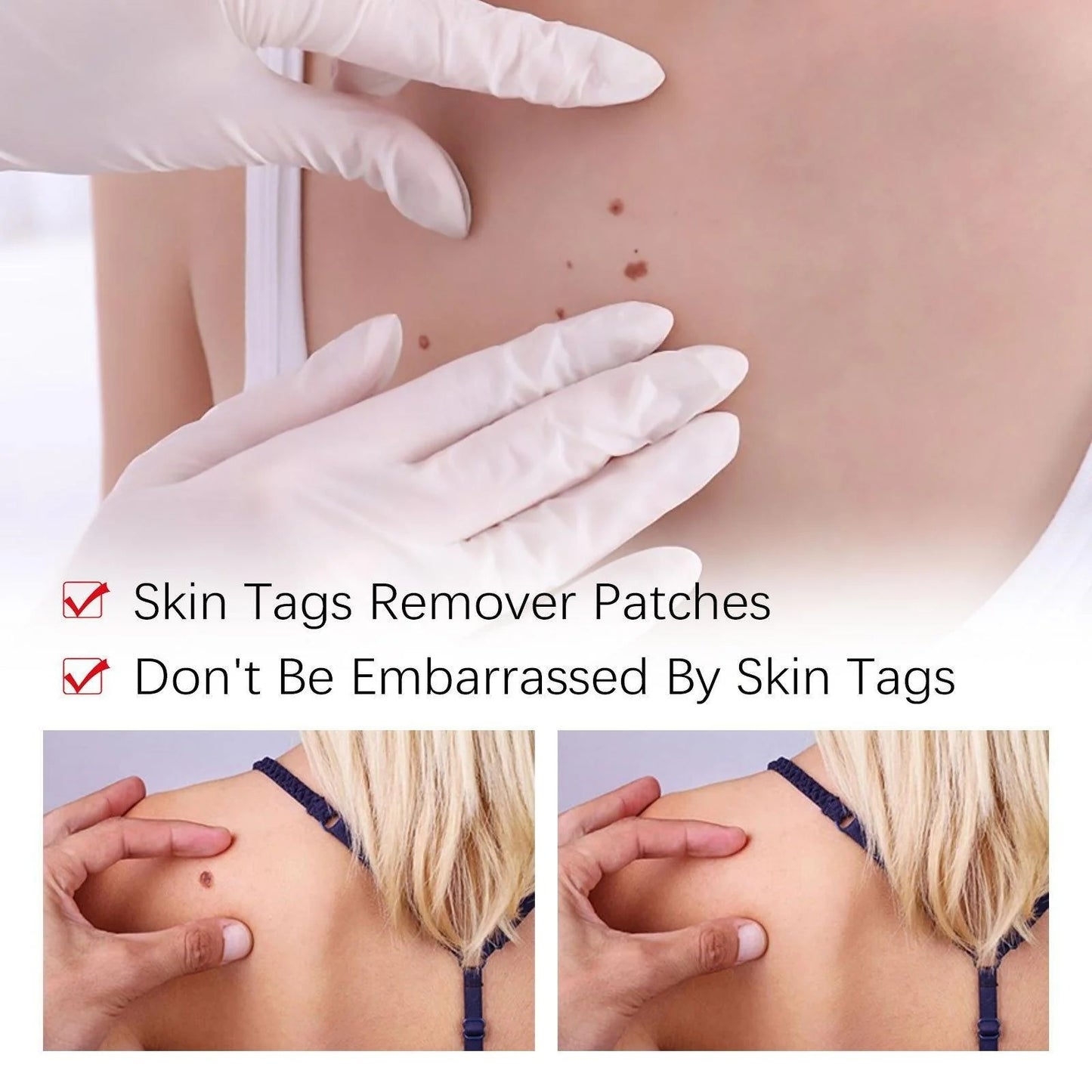 Best Sellers - Tags & Moles Remover——10 pcs